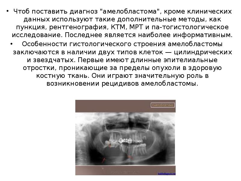 Презентация одонтогенные опухоли