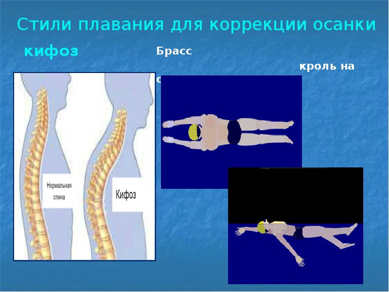 Степени кифоза грудного отдела позвоночника. Плавание при кифозе. Стили плавания для коррекции осанки. Плавание брассом при кифозе.