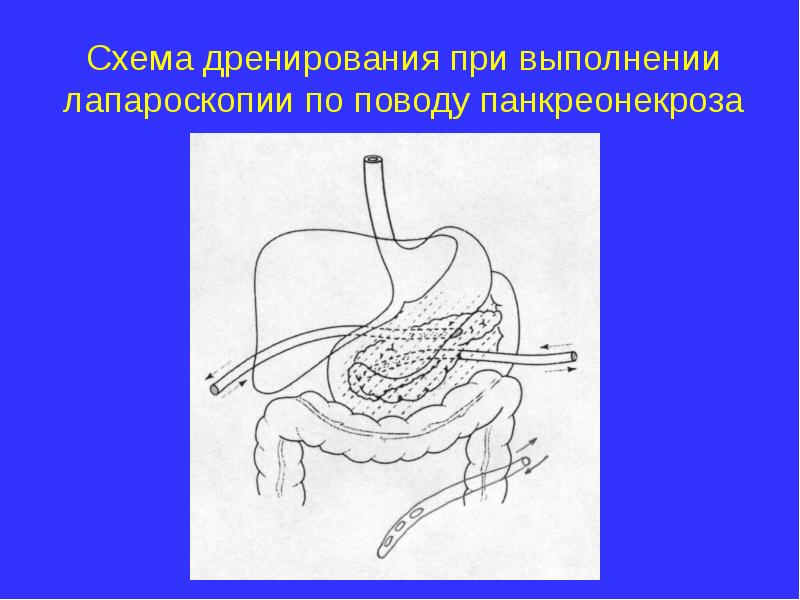 Панкреатит хирургия презентация