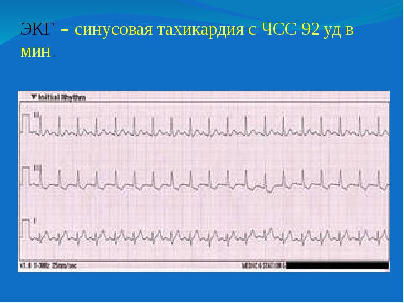 Частота синусового ритма. Чсс 150 на экг с синусовым ритмом. Синусовая аритмия с чсс. Синусовый ритм с чсс 84 уд/мин. Синусовый ритм чсс 75 уд мин.
