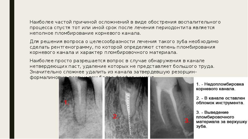 Методы лечения периодонтита презентация