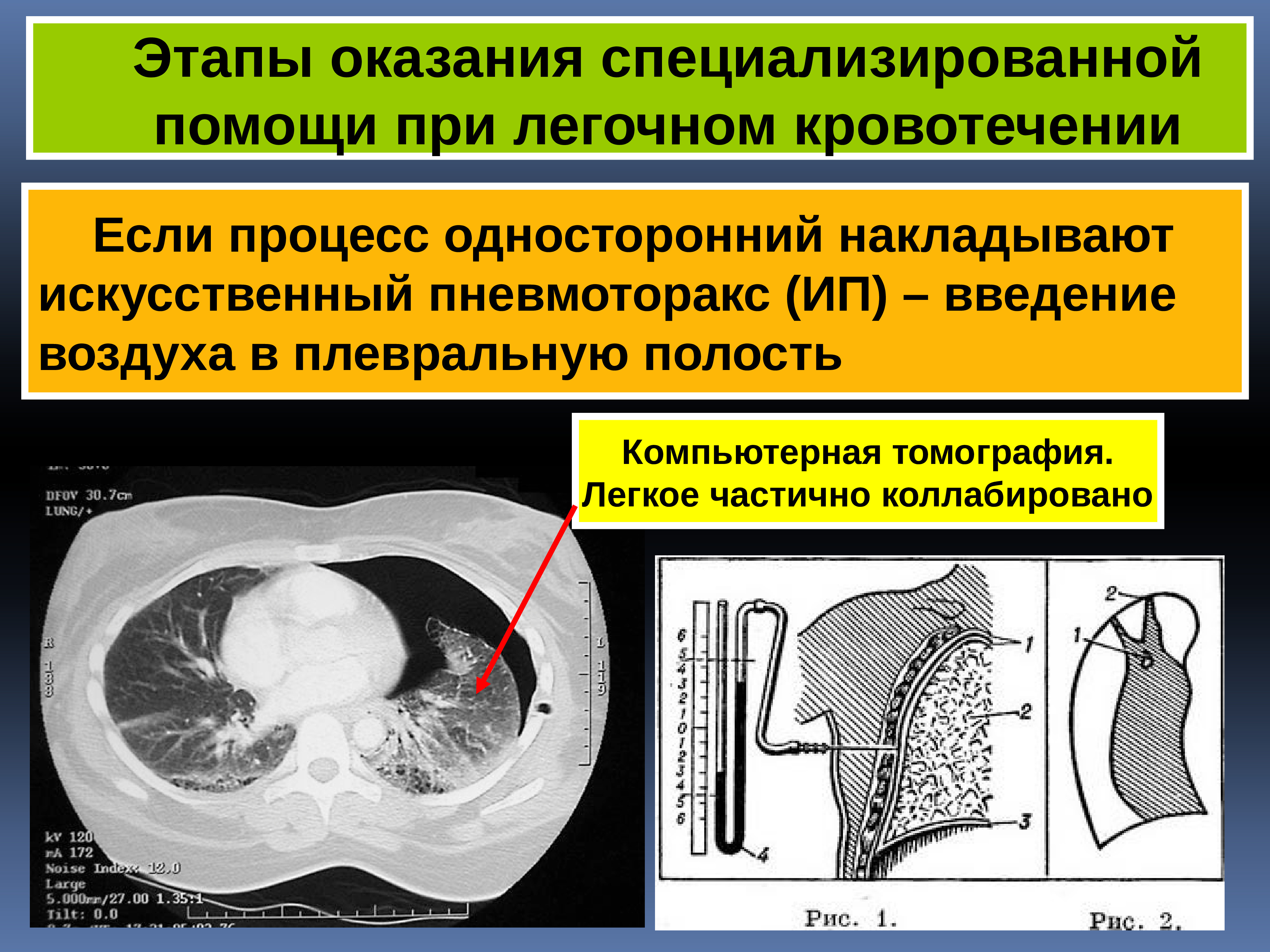 Полость стадия. Легочное кровотечение кт. Кт при легочном кровотечении. Плевральная полость кт. Лёгочное кровотечение легких при кт.