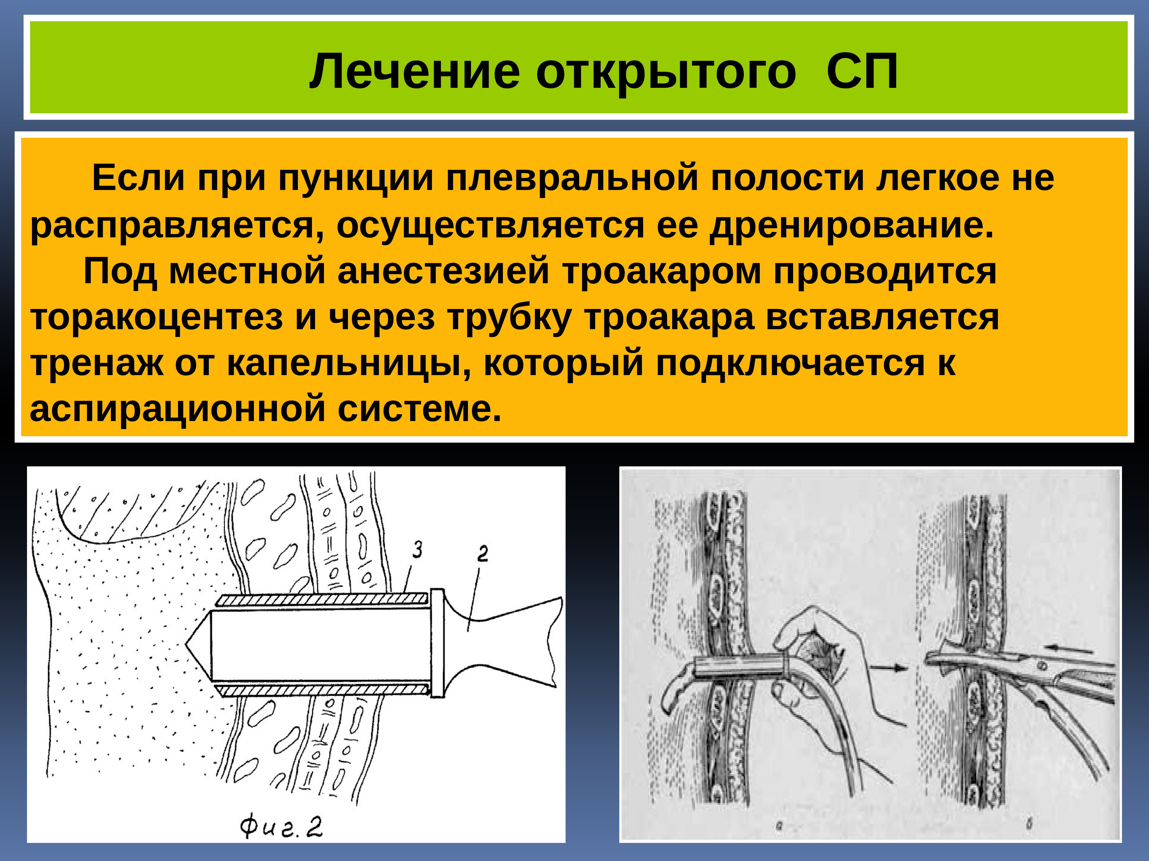 Пункция плевральной полости. Торакоцентез. Методика выполнения торакоцентеза. Пункция плевральной полости (торакоцентез). Пункции и дренирование РАН И полостей.