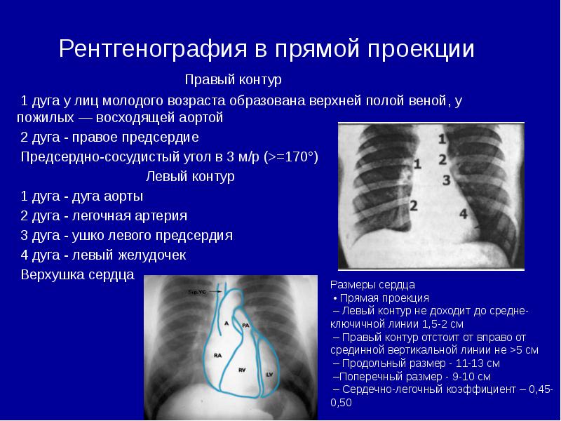 Дуги сердца на рентгенограмме схема