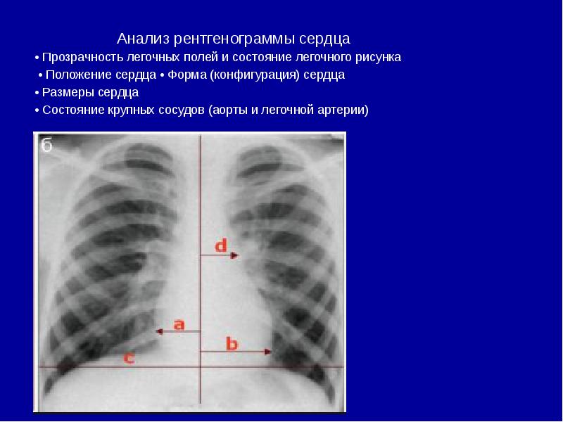 Патология легочного рисунка