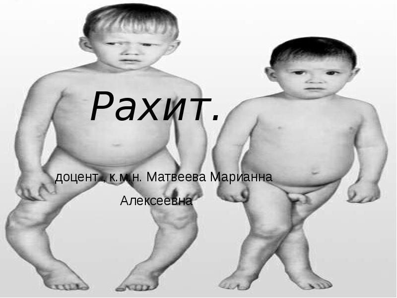 Презентация по рахиту