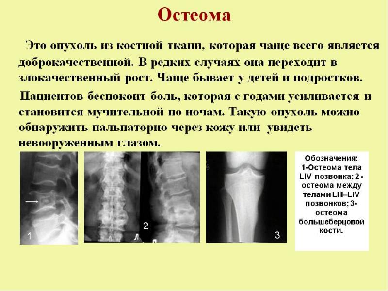 Опухоли костей схема