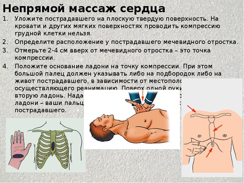 Непрямой сердца. Непрямой массаж сердца глубина продавливания грудной клетки. Оказание первой помощи непрямой массаж сердца. Техника проведения непрямого массажа сердца. Наружный непрямой массаж сердца.