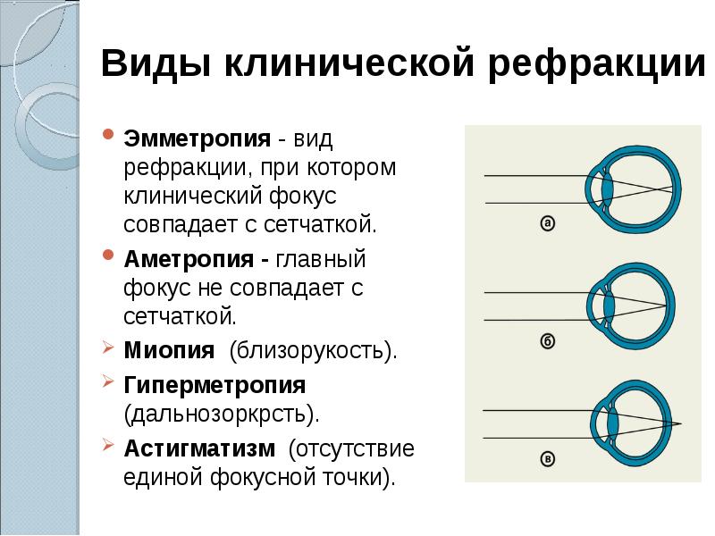 Рефракция глаза презентация