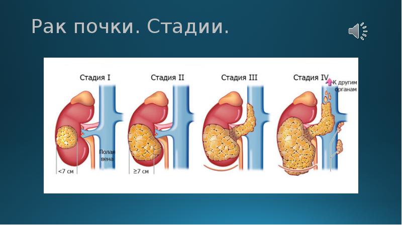 Рак третий степени. Онкология почек стадии. Опухоль почки 3 степени. Карцинома почки 2 стадия.