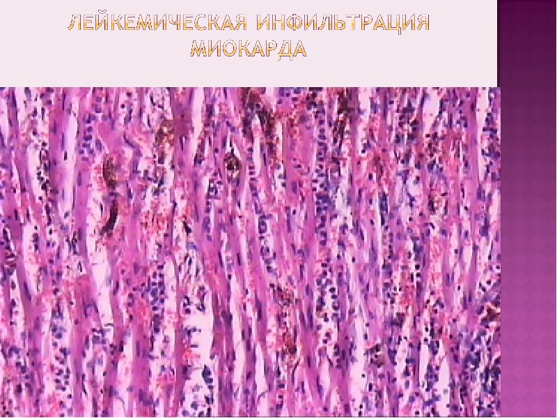 Болезни системы крови презентация