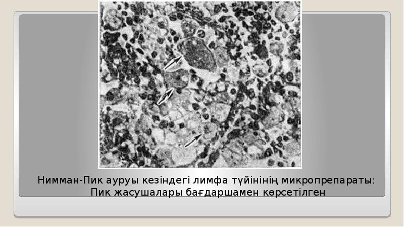 Нимман-Пик ауруы кезіндегі лимфа түйінінің микропрепараты: Пик жасушалары бағдаршамен көрсетілген 