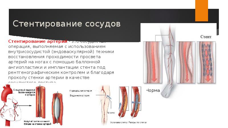Артерия ноги операция. Стентирование сосудов артерии. Стентирование сосудов эндоваскулярное. Этапы операции стентирования сосуда. Стентирование сосудов ход операции.