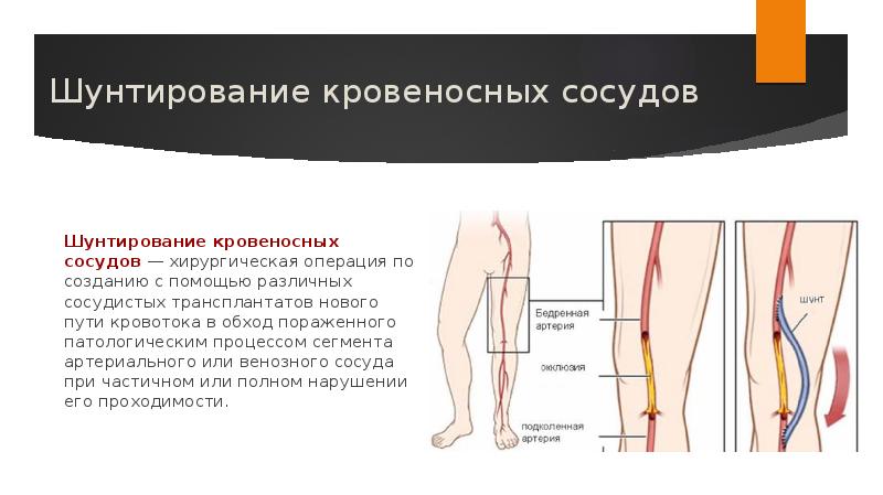 Артерия ноги операция. Шунт артерии нижних конечностей. Операция шунтирование сосудов нижних конечностей. Шунтирование при атеросклерозе сосудов. Шунтировка сосудов конечностей.