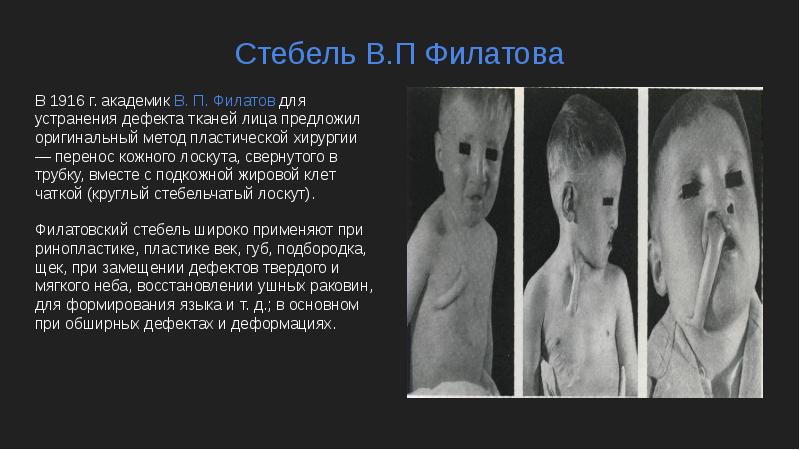Стебель В.П Филатова
В 1916 г. академик В. П. Филатов для Стебель В.П Филатова
В 1916 г. академик В. П. Филатов для