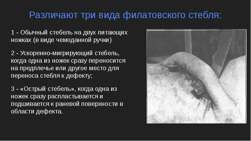 Различают три вида филатовского стебля:
1 - Обычный стебель на двух Различают три вида филатовского стебля:
1 - Обычный стебель на двух