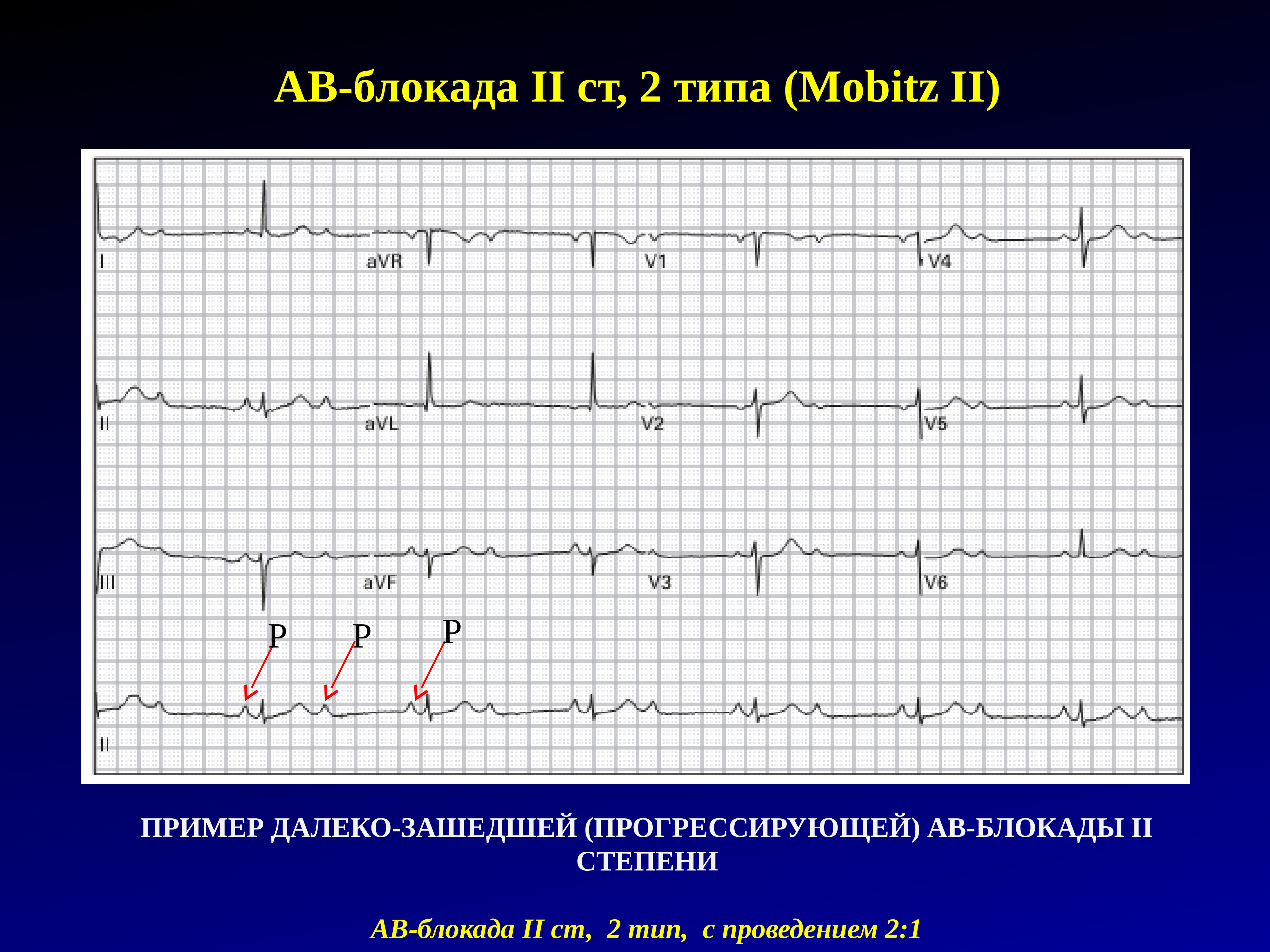 Ав блокада. Атриовентрикулярная блокада 2 степени типа Мобитц 1 характеризуется. АВ блокада 2 ст 1 типа. Синоатриальная блокада 2 степени Мобитц 1. АВ блокада 2 степени на ЭКГ.