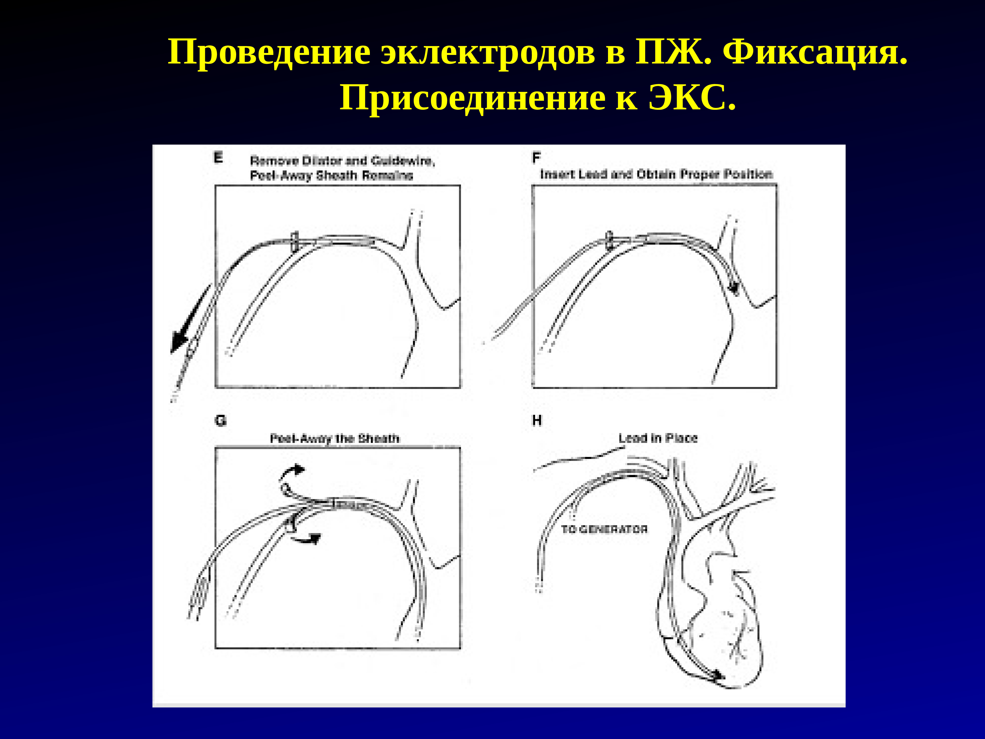 Экс примеры. Наружное вентрикулярное дренирование. экс эпикардиально. наружный вентрикулярный дренаж. показания к имплантации экс.