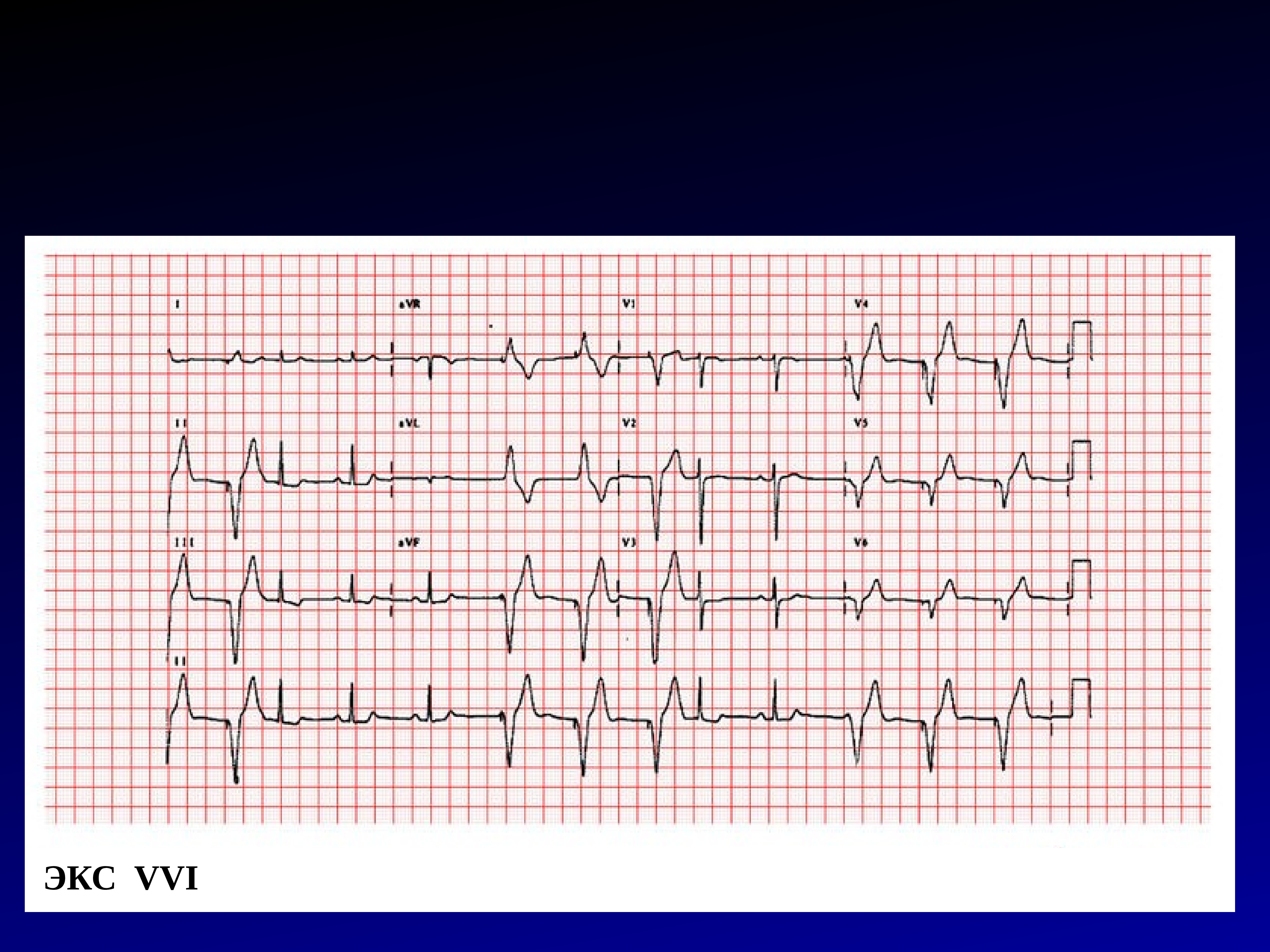 Экс это. Ритм экс в режиме VVI. Экс в режиме VVI на ЭКГ. VVI кардиостимулятор. Брадиаритмия экс.