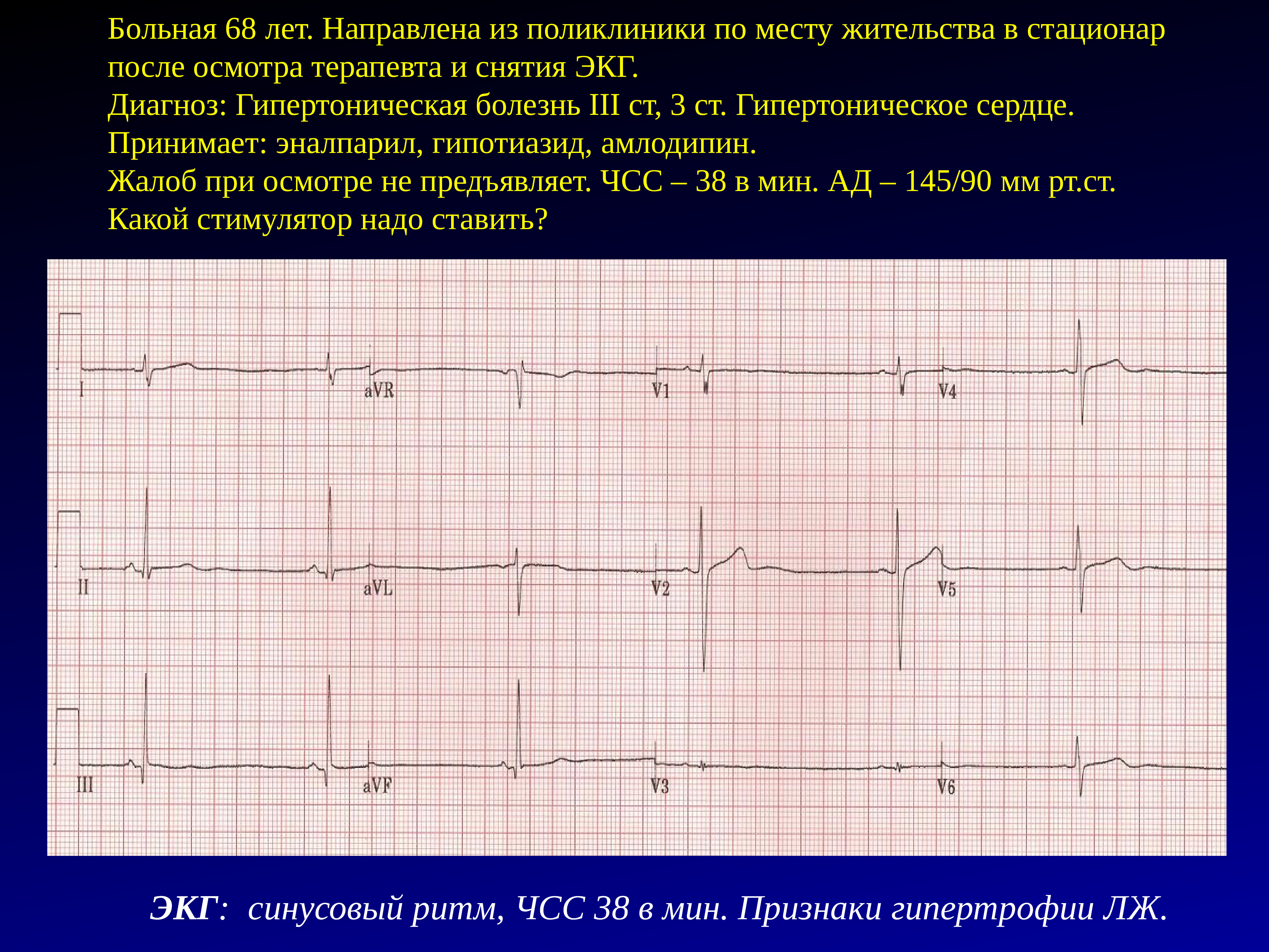 Экг презентация терапия