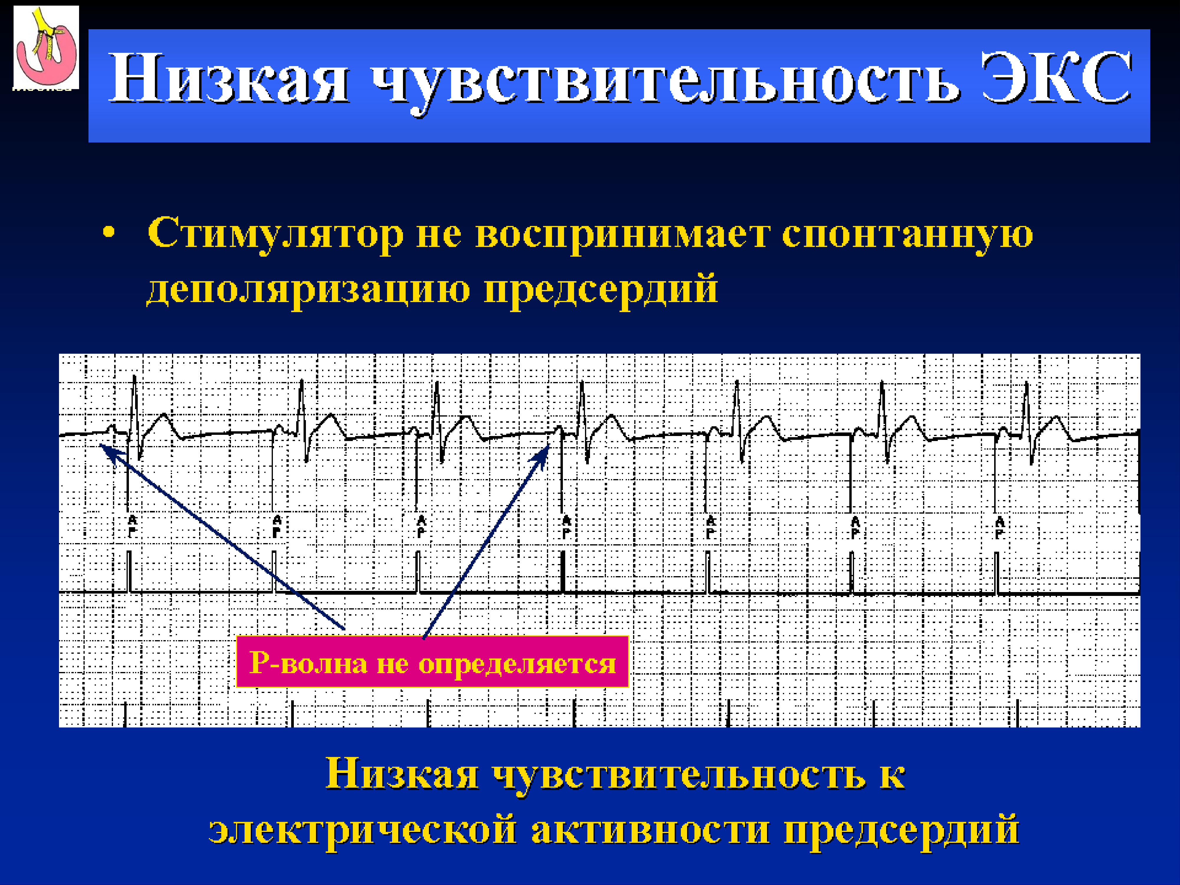 Экс это. Брадиаритмия ЭКГ. Синусовая брадиаритмия. Нарушение чувствительности экс. Гипосенсинг экс.