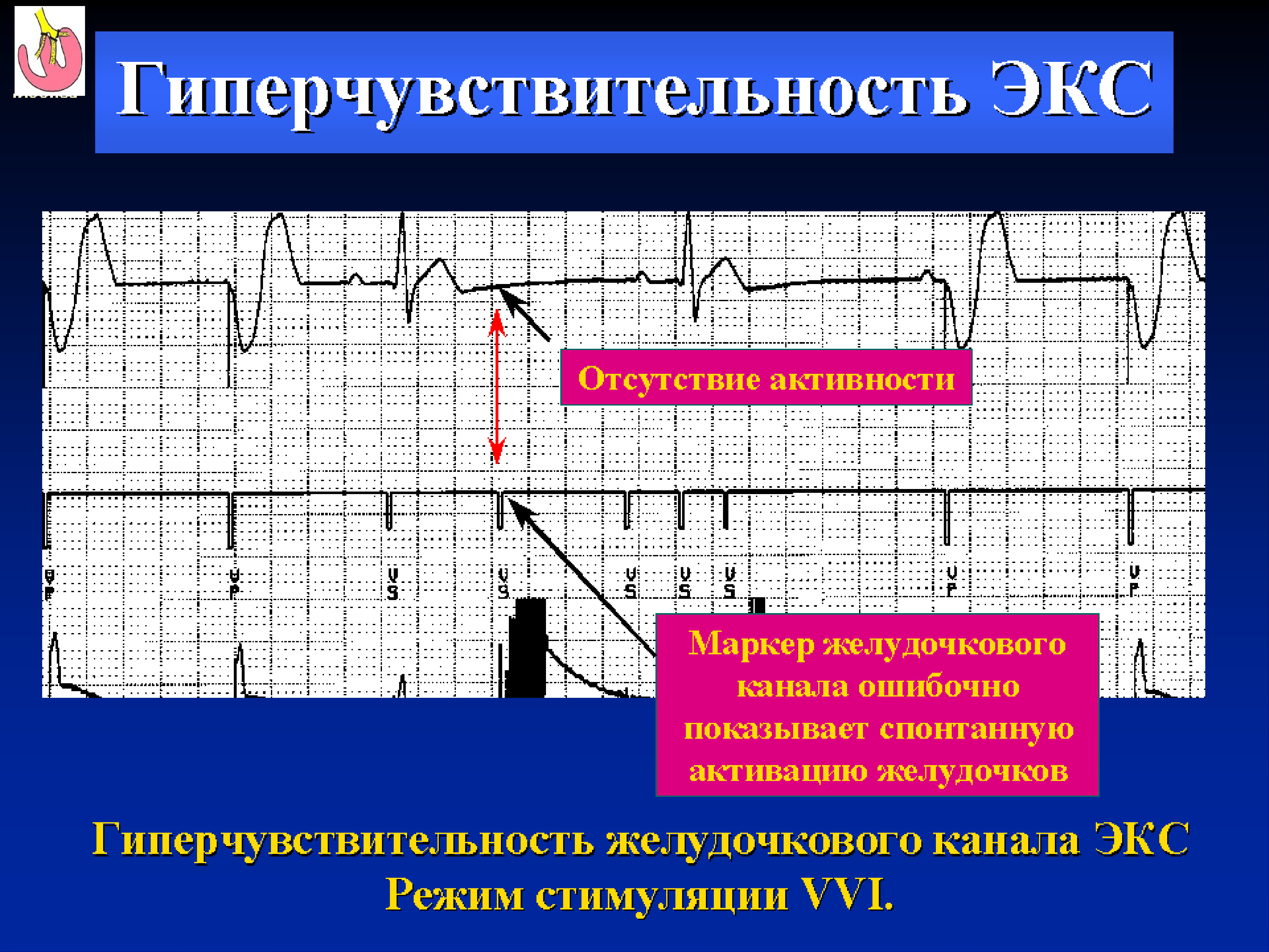 Экс это. Синусовая брадиаритмия на ЭКГ. Блокады брадиаритмии ЭКГ. Нарушение стимуляции экс. Дыхательная брадиаритмия на ЭКГ.