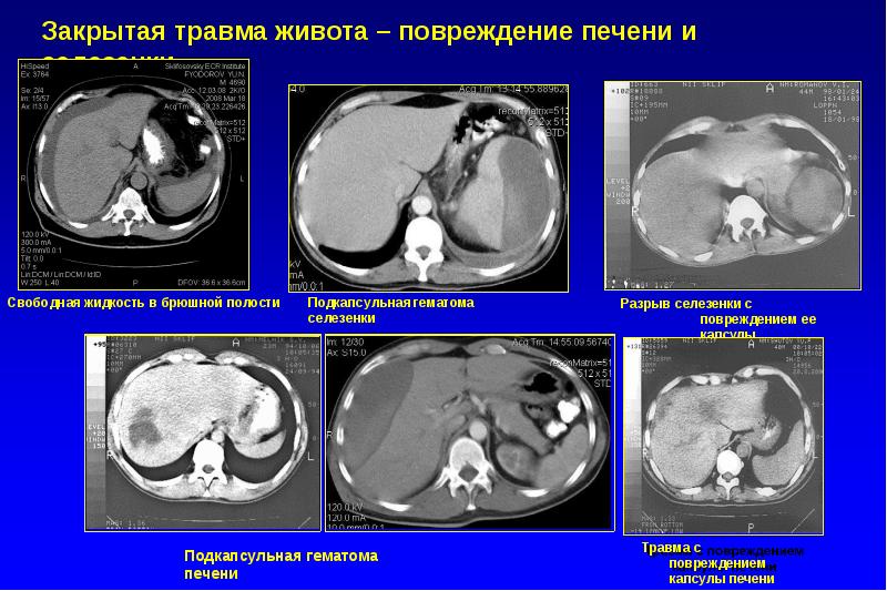 Разрыв печени и селезенки. Повреждение селезенки симптомы. Повреждения печени и селезенки. Подкапсульная гематома селезенки на кт. Одномоментный разрыв селезенки.