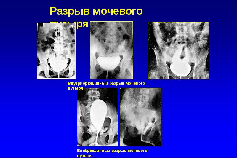 Разрыв мочевого пузыря фото