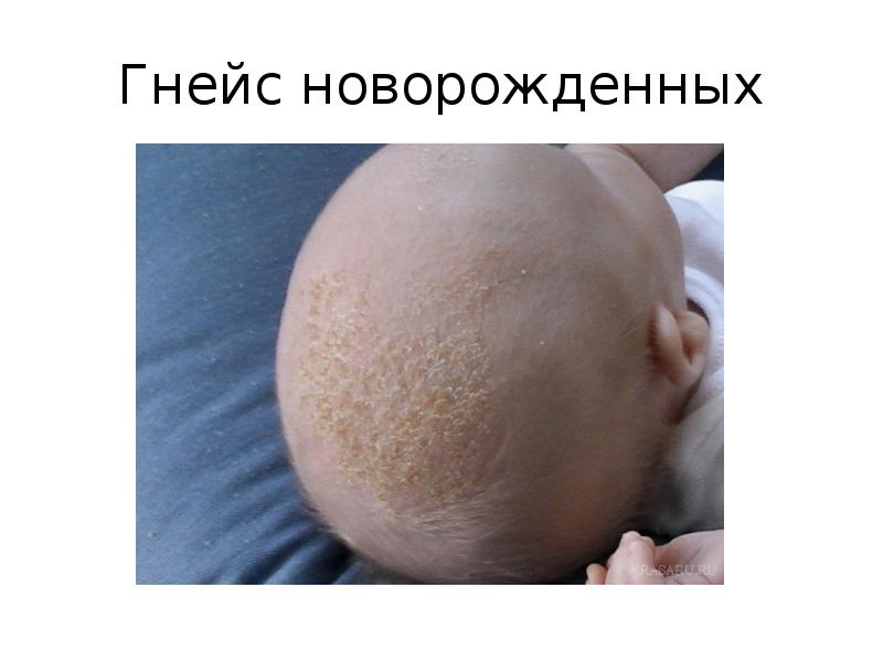 Презентация уход за кожей новорожденного