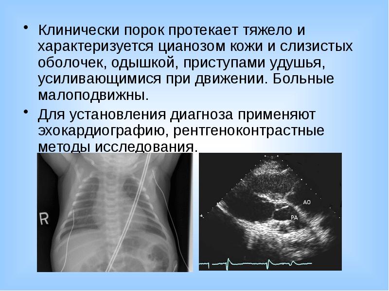 Тяжело протекает беременность. Двойниковые пороки развития. Изолированные пороки развития характеризуются поражением только. Цианоз кожи и слизистых оболочек.