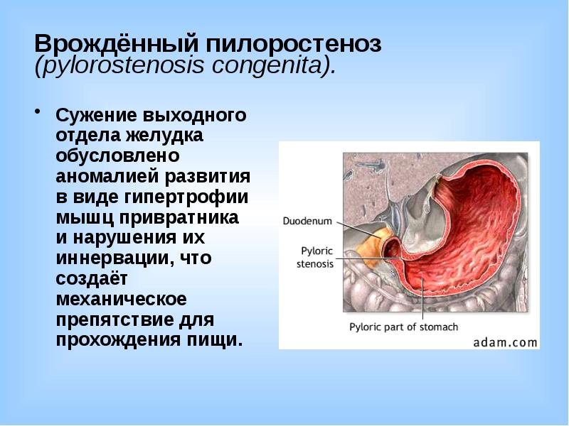 Стеноз привратника клиническая картина