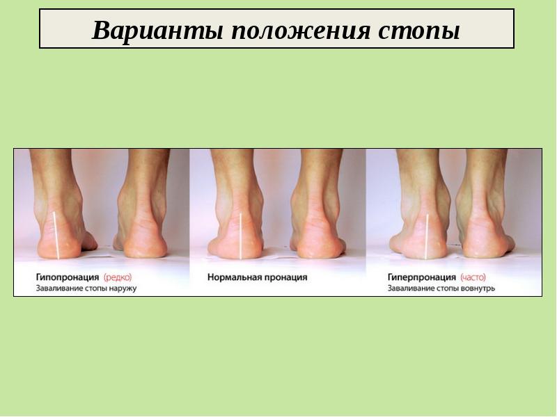 Правильное положение стопы. Вальгусная деформация стопы градусы. Формирование стопы у ребенка. Варусная деформация стопы рентген. Стопа ноги нормальное положение.