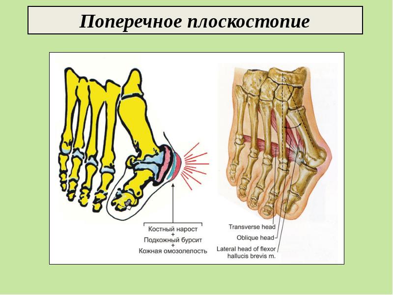 Поперечное плоскостопие. Плоскостопие анатомия. Степени плоскостопия. Поперечное плоскостопие типы.