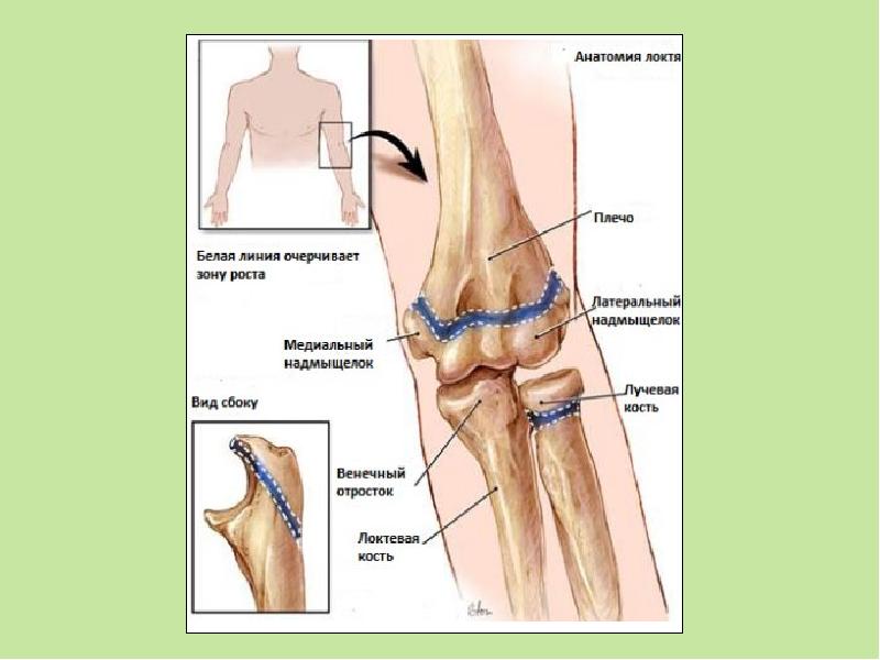 Пластина роста. Перелом венечного отростка локтевой кости. Лучевая кость зона роста. Эпифизарная пластинка лучевой кости. Перелом венечного отростка локтевого сустава.
