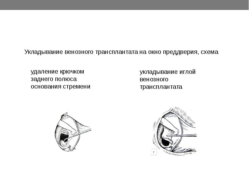 Стапедопластика отзывы. Окно преддверия. Поршневая стапедопластика. Стапедопластика уха кт протокол.