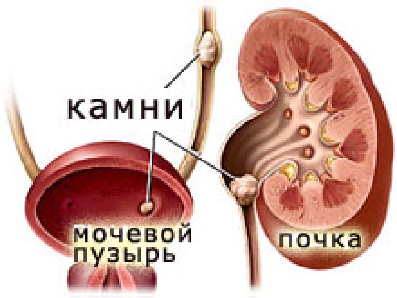 Презентация несеп тас ауруы