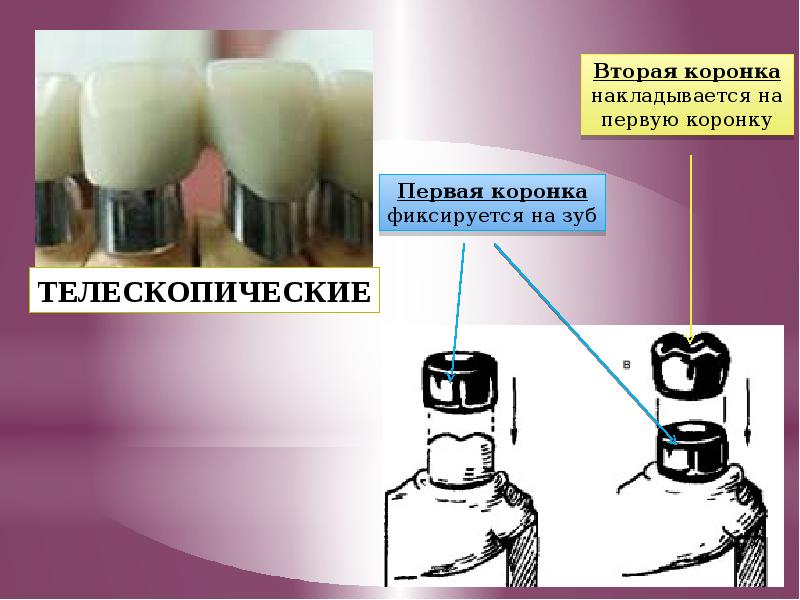 Искусственные коронки ортопедическая стоматология презентация