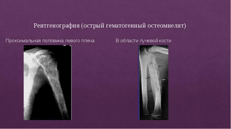 Остеомиелит рентген. Острый гематогенный остеомиелит рентген. Острый гематогенный эпифизарный остеомиелит. Гематогенный остеомиелит плечевой кости.