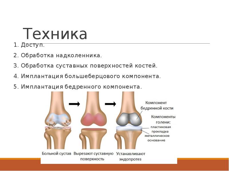 Эндопротезирование суставов презентация