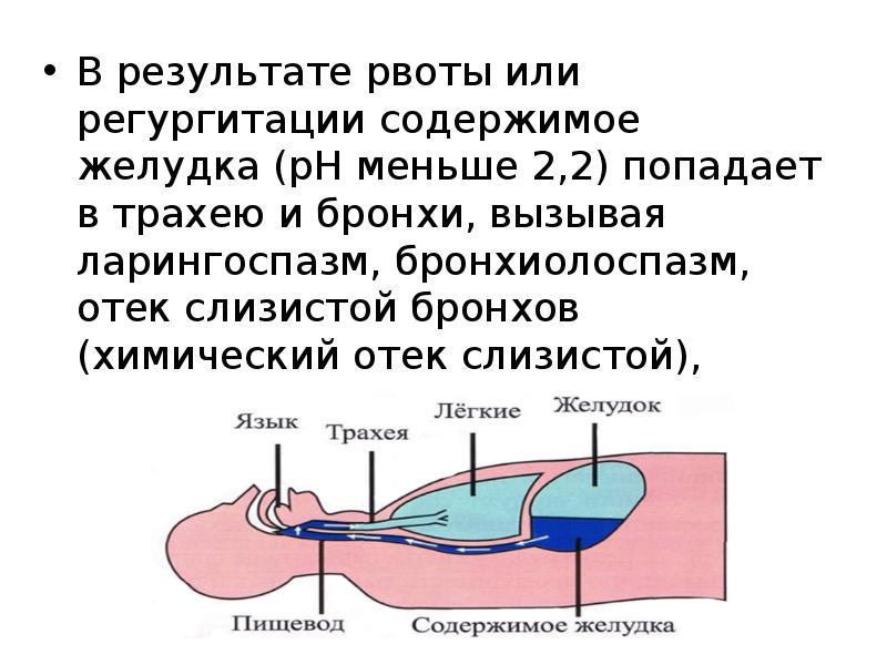 Кислот желудочного содержимого. Регургитации желудочного содержимого. Острые нарушения дыхания. Регургитация ЖКТ.