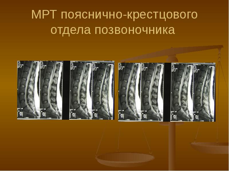 Мрт поясничного отдела. Мрт пояснично-крестцового отдела позвоночника. Мрт позвоночника. Конкресценция крестцовых позвонков мрт. Мрт позвоночника Рязань пояснично-крестцового отдела.