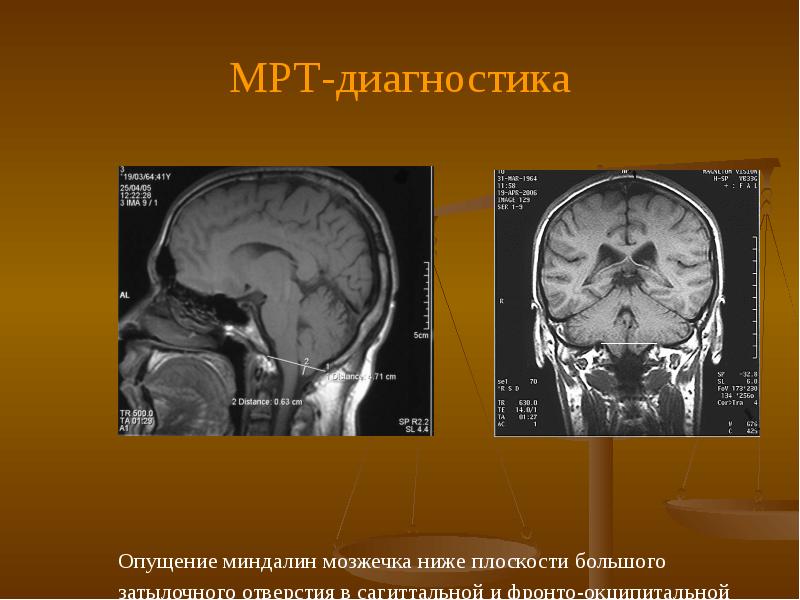 Миндалины мозжечка. Эктопия миндалин мозжечка мрт головного мозга. Дистопия миндалин мозжечка на мрт. Эктопия миндалин мозжечка кт. Эктопия миндалин мозжечка мрт.