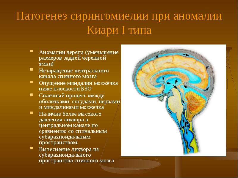 Расширение субарахноидального пространства. Ликвор в подпаутинное пространство. Субарахноидальное пространство головного мозга. Субарахноидальное пространство мозжечка. Субарахноидальное пространство головного и спинного мозга.