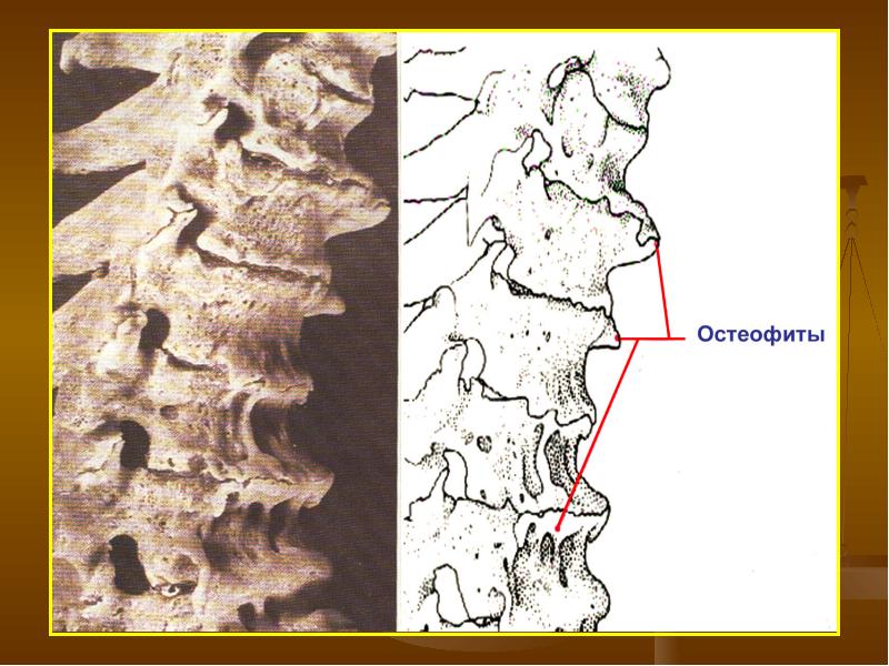 Краевые остеофиты тел позвонков что это такое фото