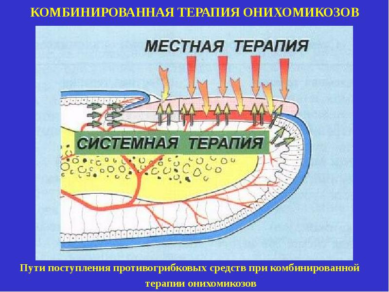 Схема лечения онихомикоза