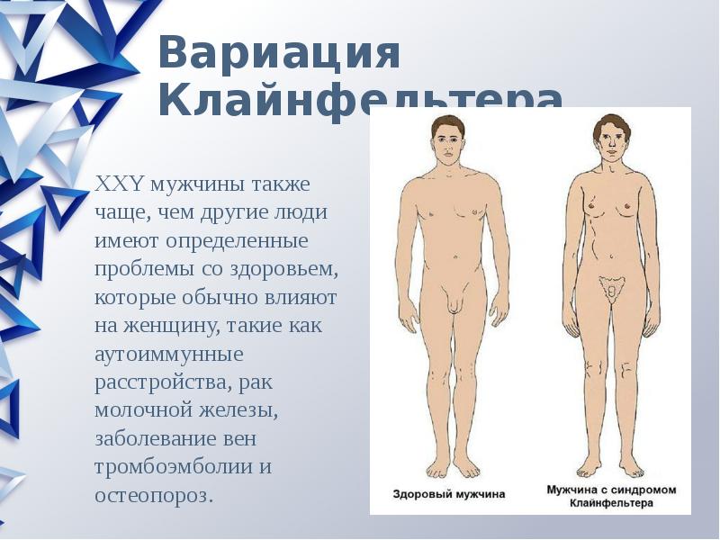 Клиническая картина синдрома клайнфельтера