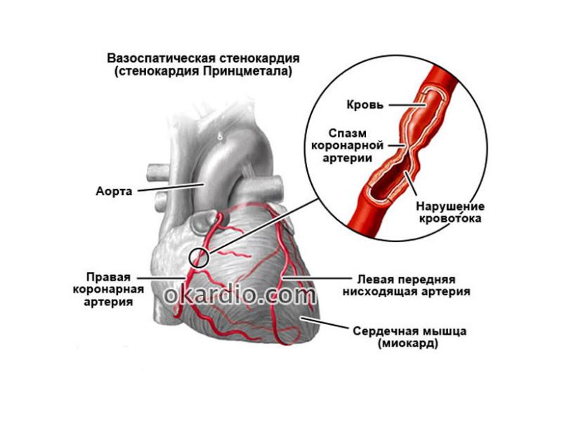 Спазм сосудов это. Стенокардия Принцметала патогенез. Стенокардия Принцметала симптомы. Стенокардия Принцметала причины. Вазоспастическая стенокардия Принцметала.