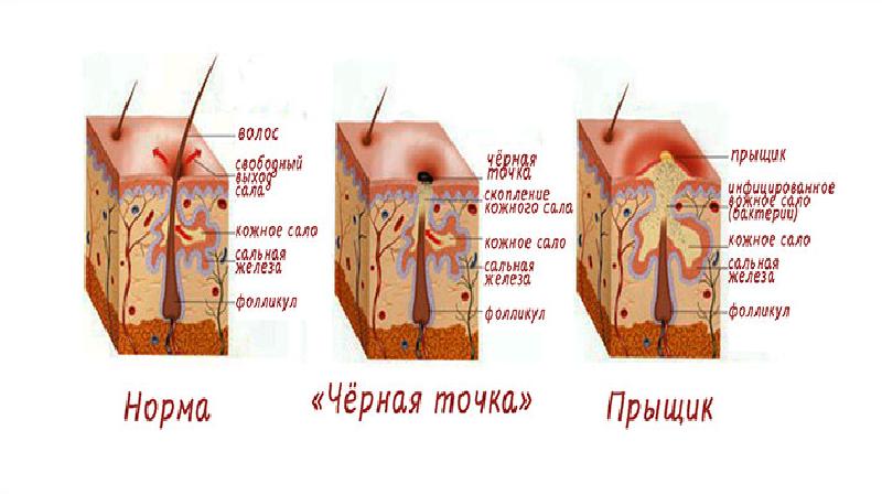 Презентация лечение акне