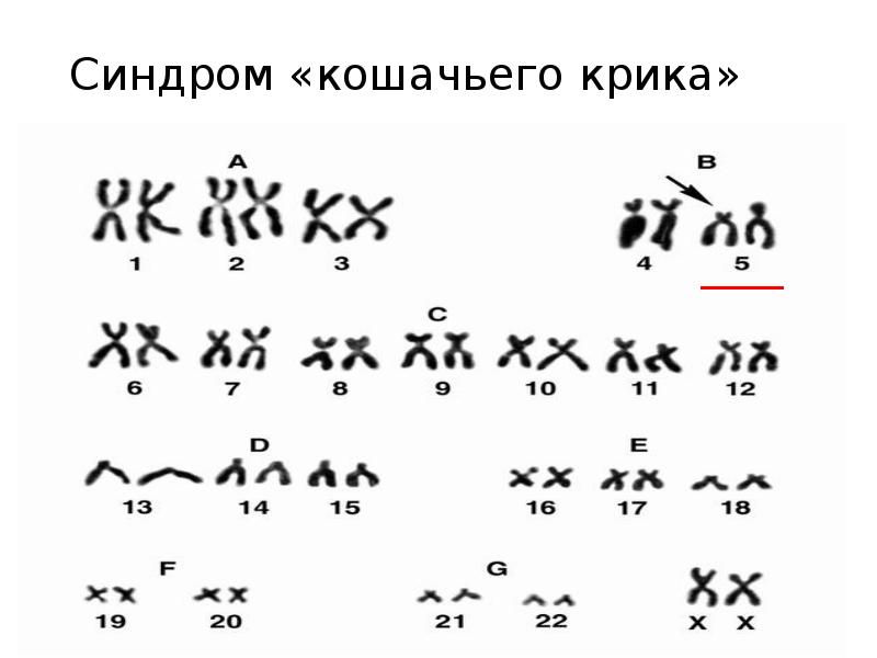 Каким номером на рисунке обозначен тип мутации характерный для больных с синдромом кошачьего крика