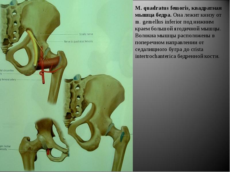 Седалищная кость. Quadratus femoris мышца. Квадратная мышца бедра (m. Quadratus femoris). Седалищный бугор анатомия. Седалищная кость мышцы.